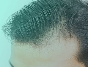 Dr Daood Cosmetic Surgery - FUT & FUE Hair Service
